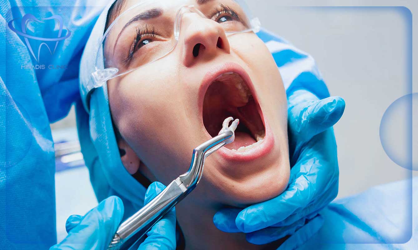 درد جراحی دندان عقل 