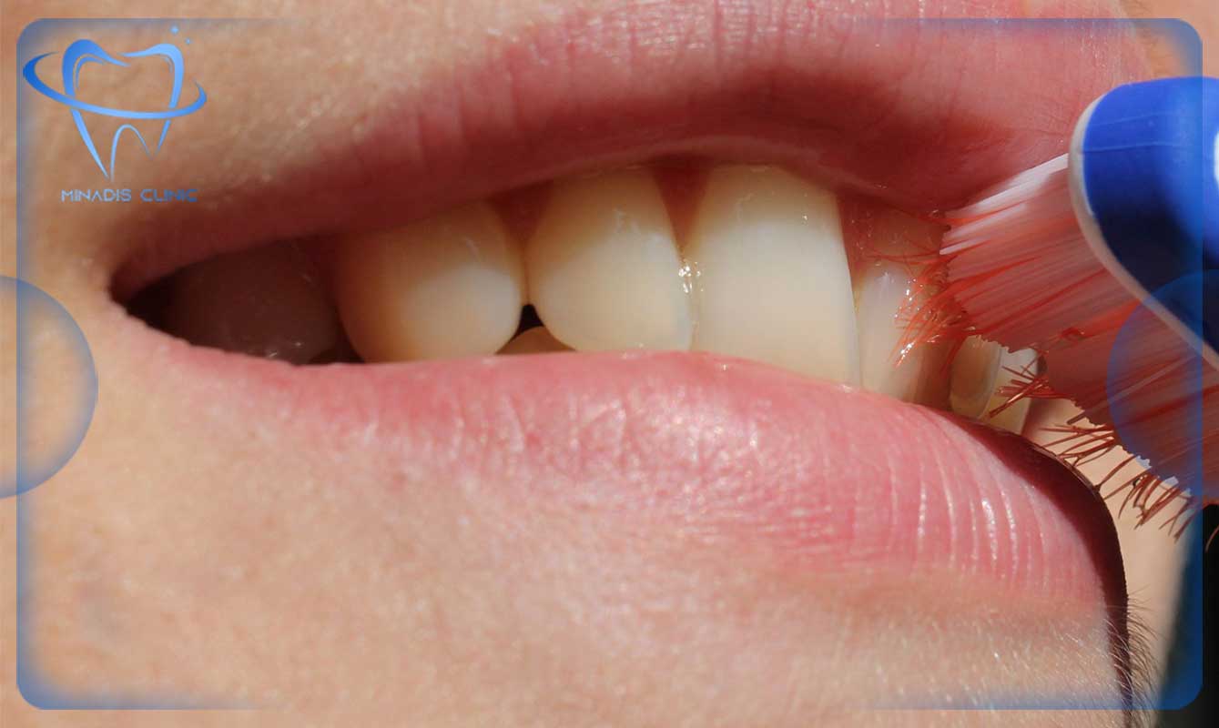 بیماری صبحگاهی و فرسایش مینای دندان