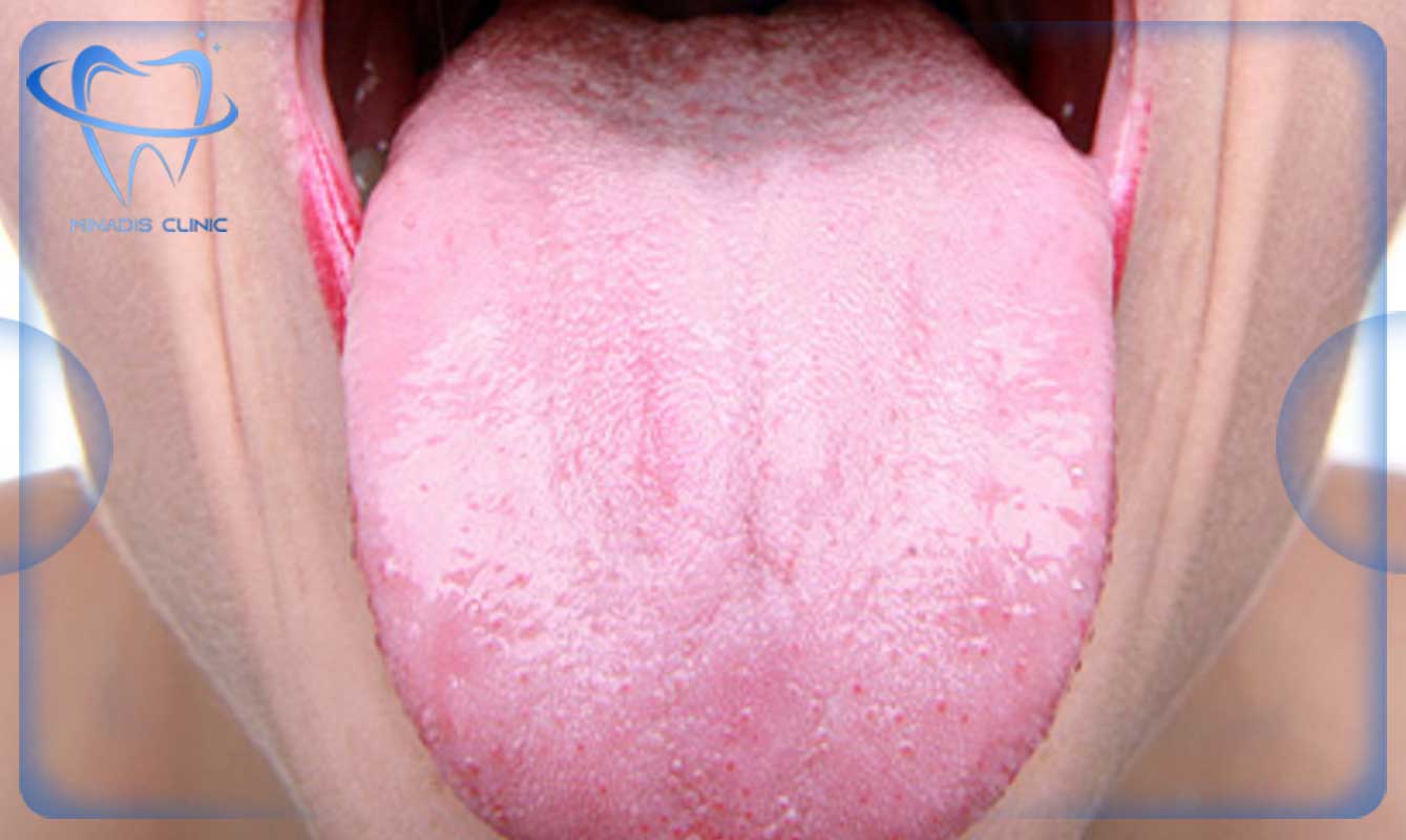 باکتری‌های زبان و بوی بد دهان در ماه رمضان