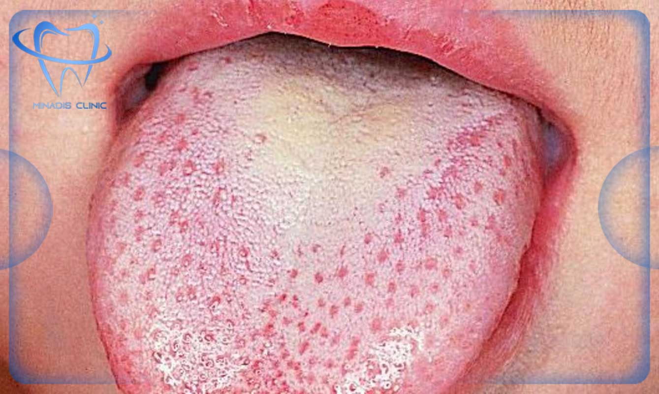 آیا تمیز کردن زبان با مسواک کافی است؟