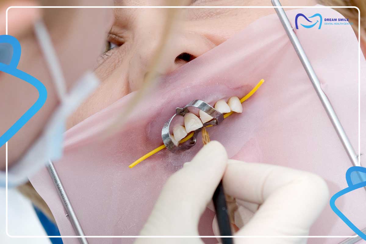 فرایند درمان عصب کشی دندان جلویی