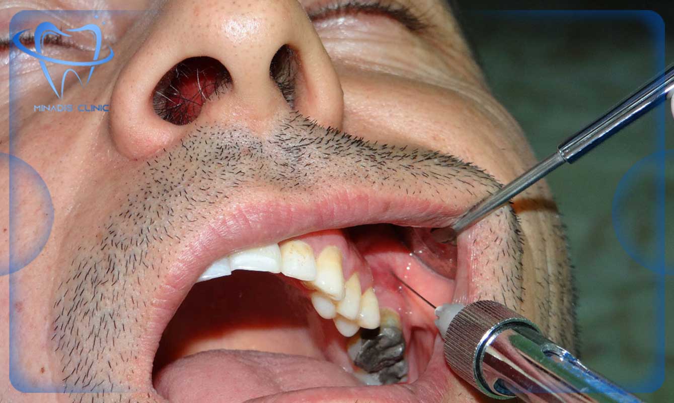 آشنایی با بی حسی موضعی در دندانپزشکی